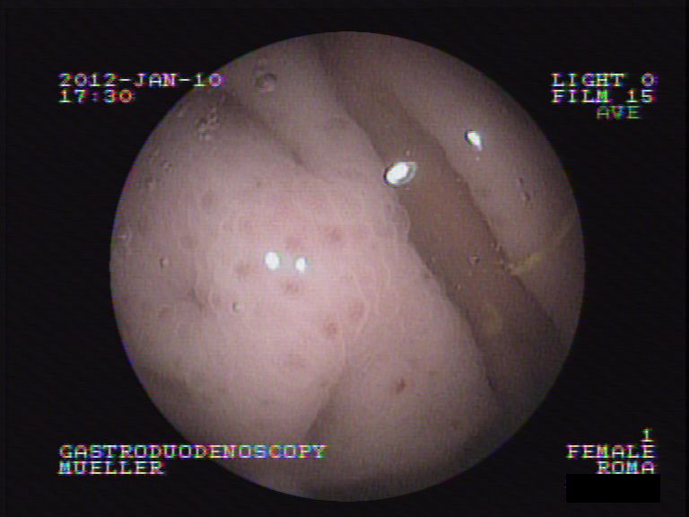 Roma Magenspiegelung 1