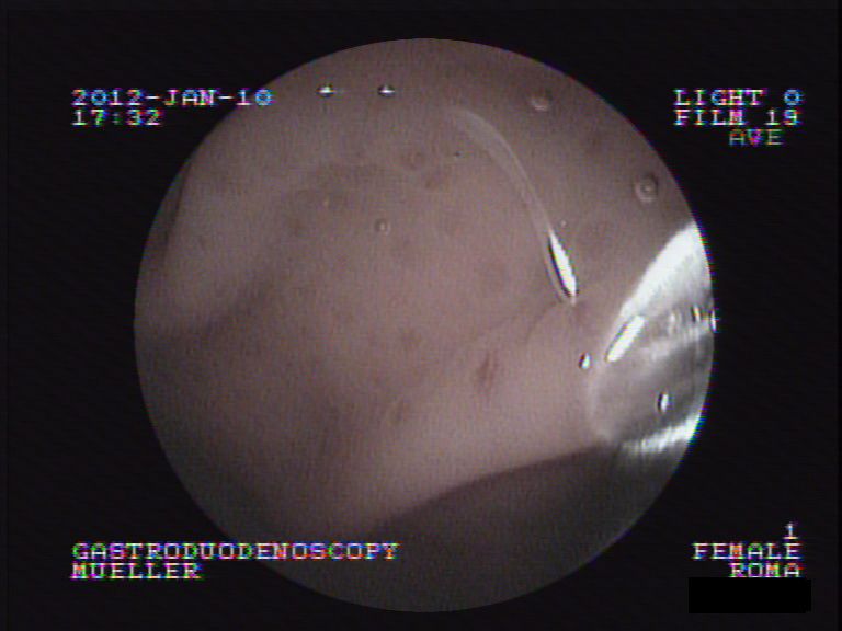 Roma Magenspiegelung 2