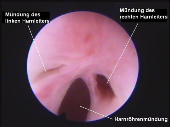 Gipsy Urethro-Cystoskopie