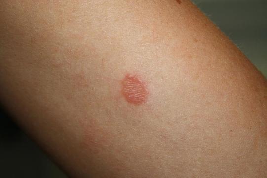 Barbas Weiterer Verlauf 2