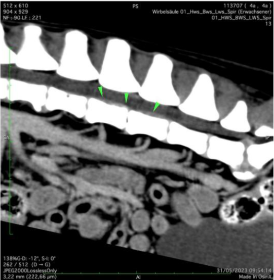CT Wirbelsäule longitudinal