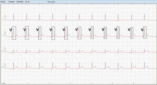 EKG Normal