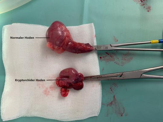 Hoden nach Entfernung