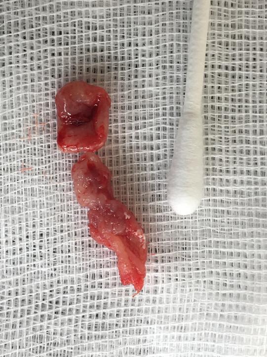 Gewebeuntersuchung und Schlussdiagnose