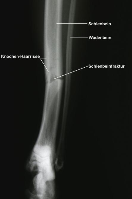 Schienbeinbruch