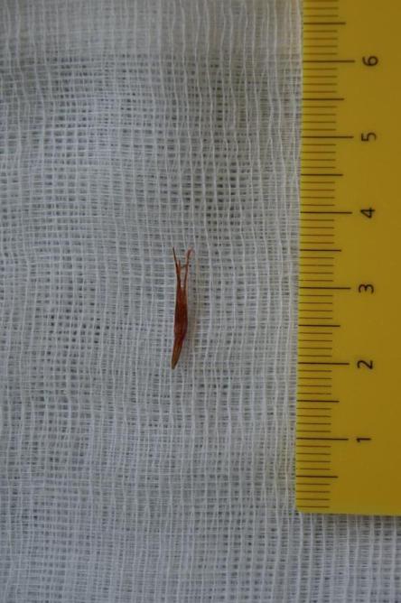 Zwischenzehenabszess/Fremdkörper