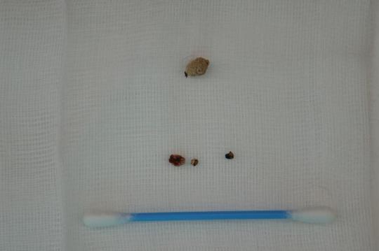 Blasen-/Harnröhrensteine