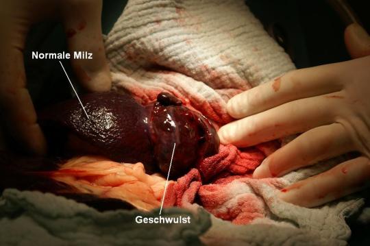 Milzgeschwulst