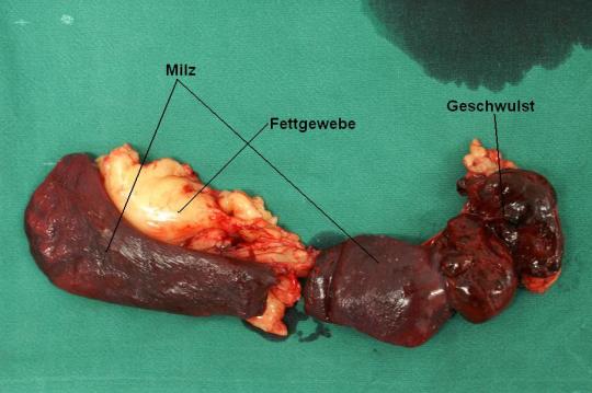 Milzgeschwulst