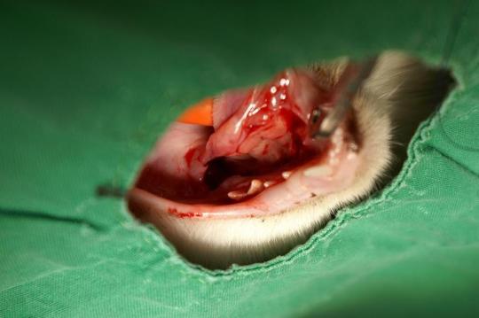 Speichelcyste (Ranula)