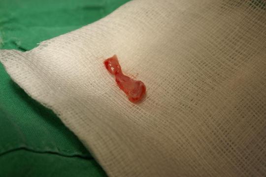 Speichelcyste (Ranula)