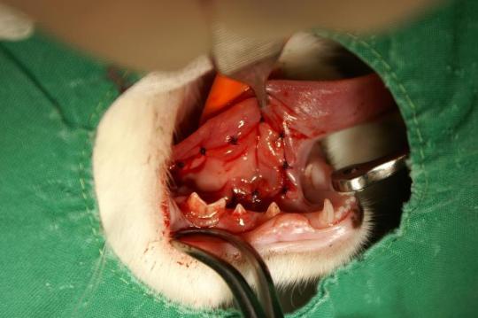 Speichelcyste (Ranula)