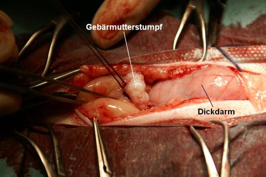 Problematische Empfängnisverhütung