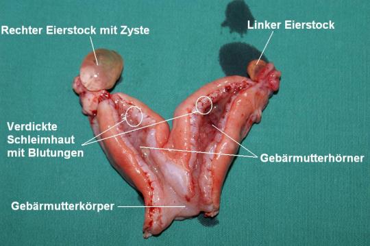 Problematische Empfängnisverhütung