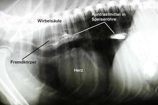 Speiseröhrenfremdkörper