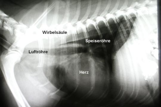 Speiseröhrenfremdkörper