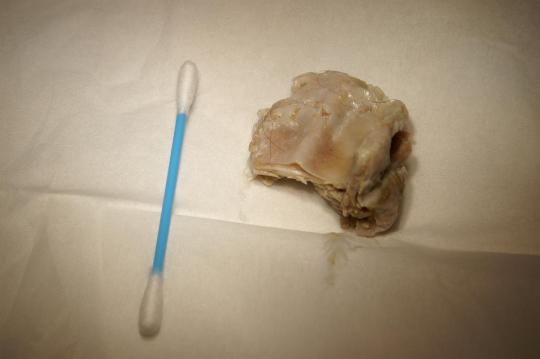 Speiseröhrenfremdkörper