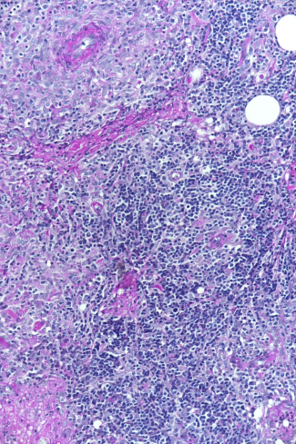 Mikroskopische Aufnahme des Gewebes - starke Vergrösserung. Bei den dunklen Punkten handelt es sich um Entzündungszellen. Aufnahme: Dr. U. Hetzel