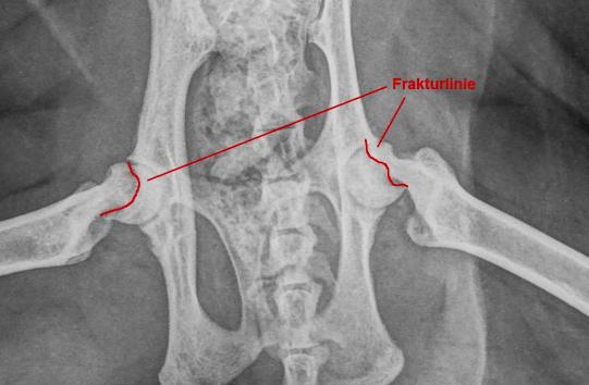 Detailaufnahme des Beckens mit eingezeichneten Frakturlinien