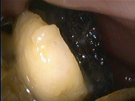 Fremdkörper im Magen