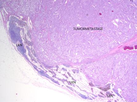 Gewebebefund: Lymphknoten-Metastase des Insulinoms, © Dr. N. Kühn, Kühn Pathologie AG