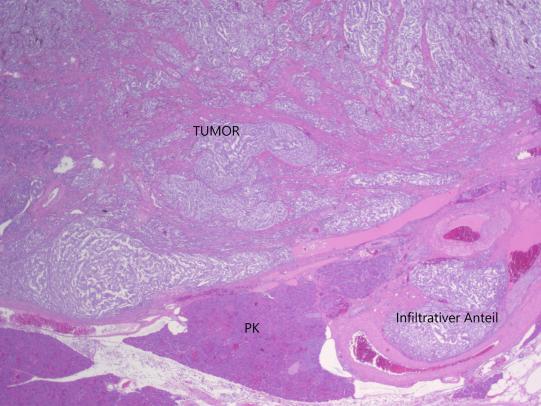 Gewebebefund: Primärtumor (Inselzellkarzinom) in der Bauchspeicheldrüse (PK), © Dr. N. Kühn, Kühn Pathologie AG