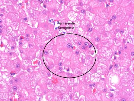 Gewebebefund: Lebertumor (Karzinom), © Dr. N. Kühn, Kühn Pathologie AG