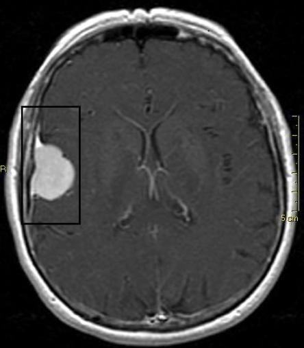 MRT eines Meningeoms beim Mensch (Quelle: Wikipedia)
