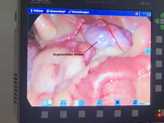 Situation intraoperativ