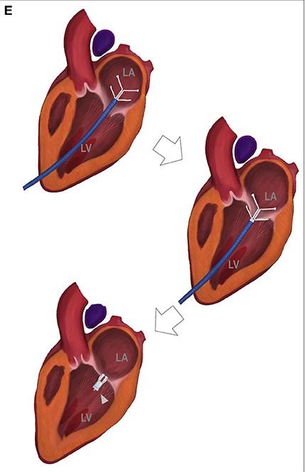 Copyright B. Liu et al: Preliminary Outcome of a Novel Edge-to-Edge Closure Device to Manage Mitral Regurgitation in Dogs, Front. Vet. Sci., 17 December 2020